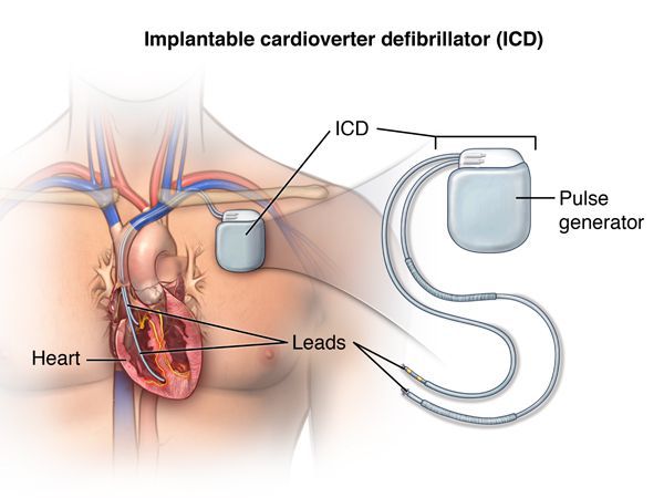 Имплантация кардиовертера-дефибриллятора