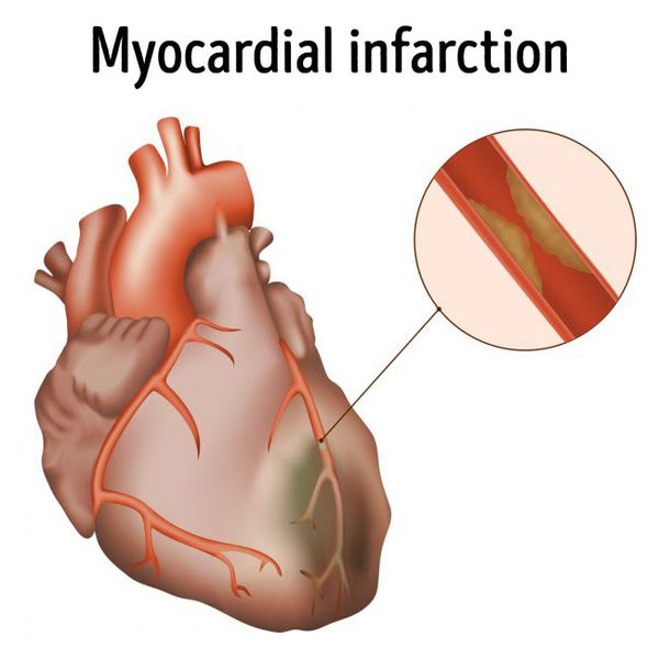 infarkt miokarda s