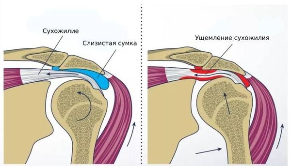 Боль в суставах