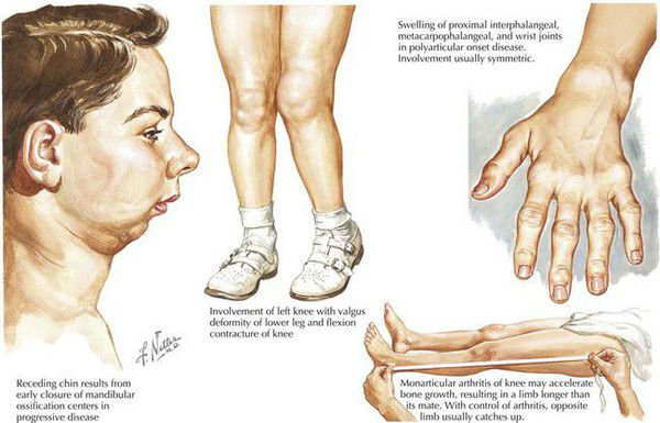 Симптомы ювенильного артрита