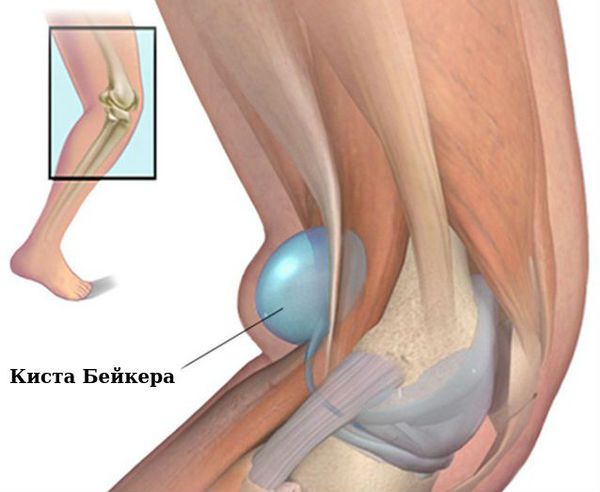 operacije koljena boli