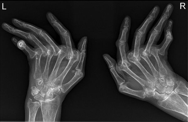 rentgenografiya sustavov s