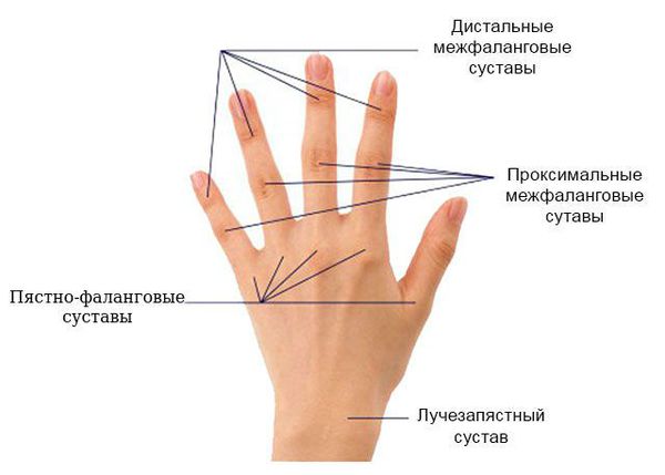 Clinica de artrită de artrită a eliminat durerea articulară a degetelor