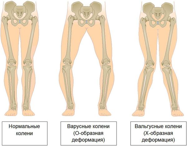 Деформация нижних конечностей в результате запущенного артроза коленных суставов