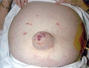 Увеличение живота и выпячивание пупка при асците [13]