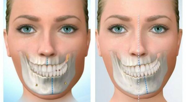 Асимметрия челлюсти