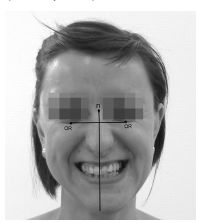 Смещение подбородка [11]