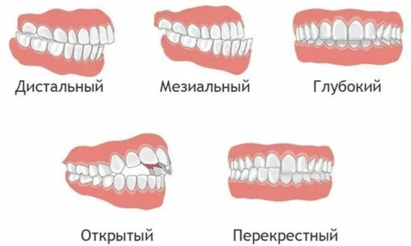 Виды неправильного прикуса