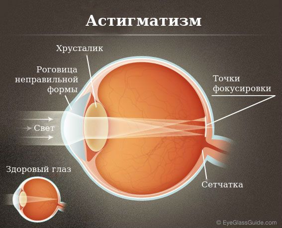 Здоровый глаз и астигматизм