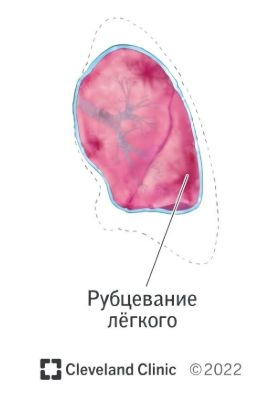Фиброателектаз