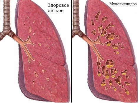 Муковисцидоз