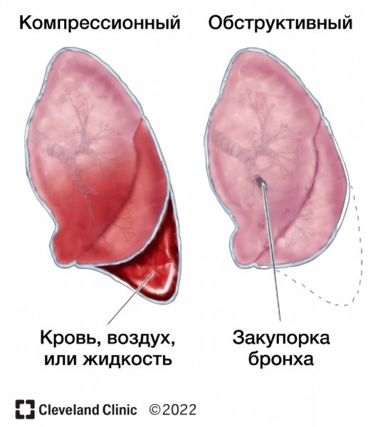 Виды ателектазов