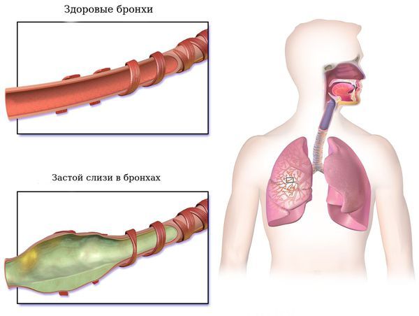 Застой слизи в бронхах
