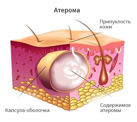 Атерома на теле