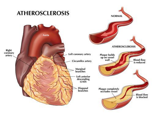 Атеросклероз и его диета