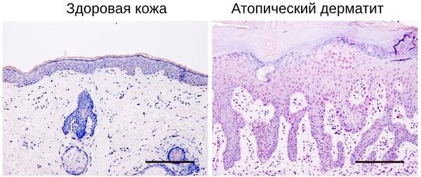 Строение ткани при атопическом дерматите [28]