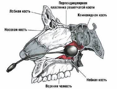 Баллон-катетер ЯМИК [1]