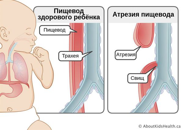 Анатомия атрезии пищевода