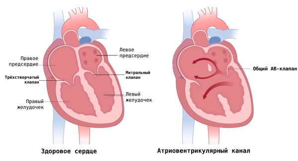 Сердце в норме и при атриовентрикулярном канале