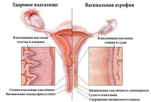 Атрофический кольпит (атрофический вагинит)