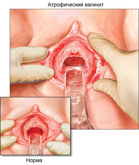 atroficheskiy vaginit s