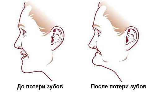 «Старческое» выражение лица