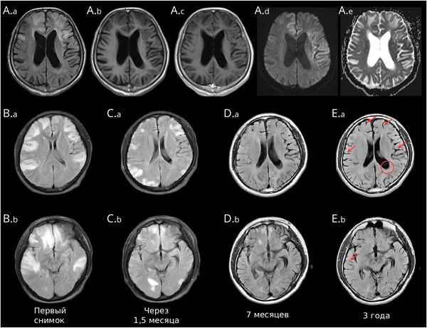 Аутоиммунный энцефалит [16]