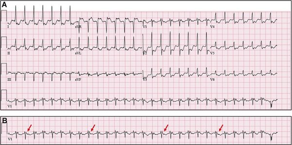Инвертированные зубцы P [13]