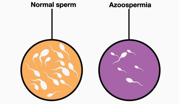 Семенная жидкость в норме и азооспермия