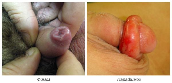 Фимоз и парафимоз Фимоз и парафимоз