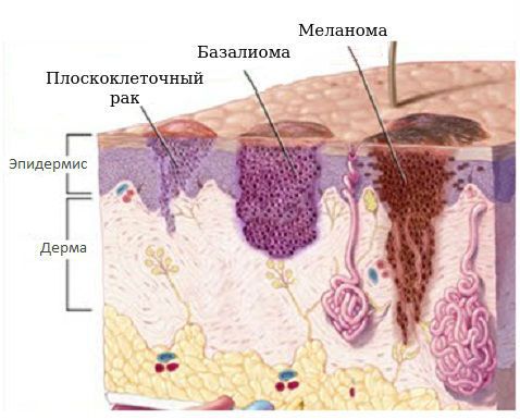 Плоскоклеточный рак