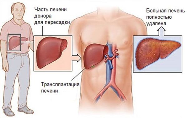 Что наиболее характерно для первичного билиарного цирроза печени