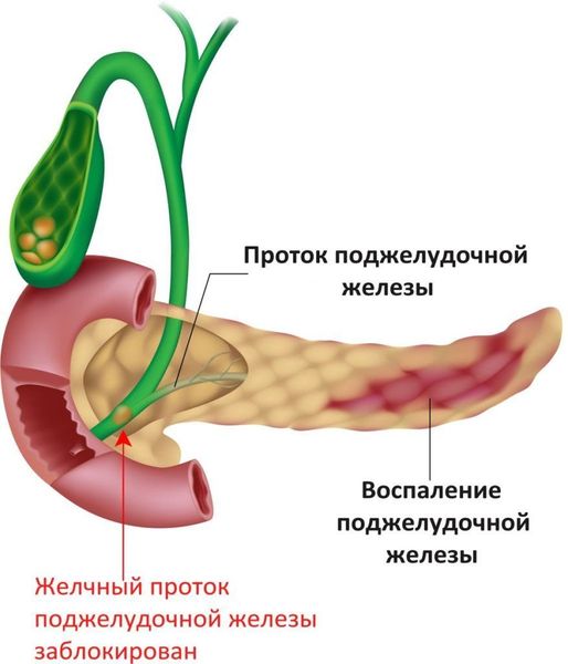 Камень в протоке, который нарушает отток желчи в двенадцатиперстную кишку Камень в протоке, который нарушает отток желчи в двенадцатиперстную кишку