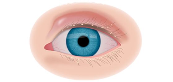 Блефароконъюнктивит Блефароконъюнктивит