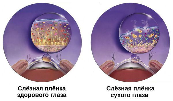 Истончённая слёзная плёнка Истончённая слёзная плёнка