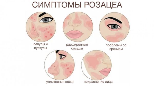 Розацеа Розацеа