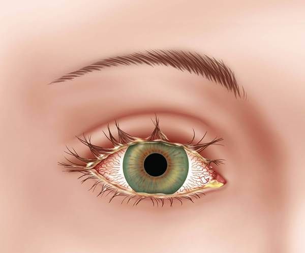 Выделение гноя из глаз Выделение гноя из глаз