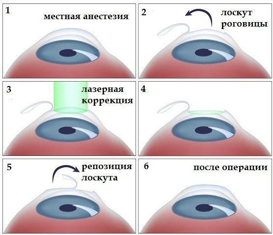 Лазерная коррекция зрения