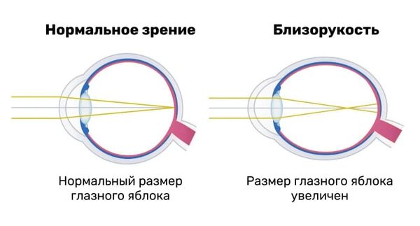 Миопия