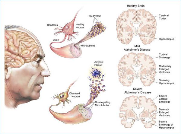 Стадии болезни Альцгеймера