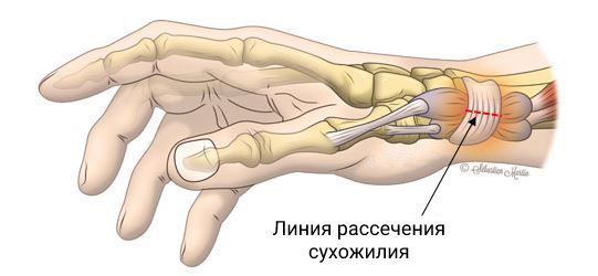 Болезнь или синдром Де Кервена