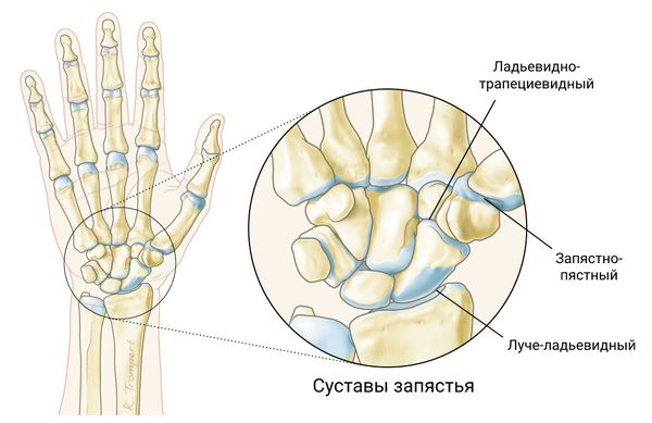 Болезнь де кервена картинки