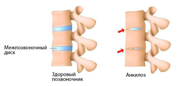 Остерохондроз грудного отдела позвоночника