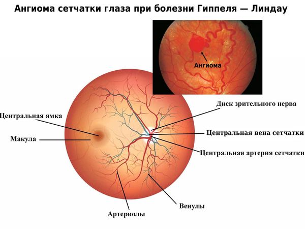 Ангиома сетчатки глаза при болезни Гиппеля — Линдау