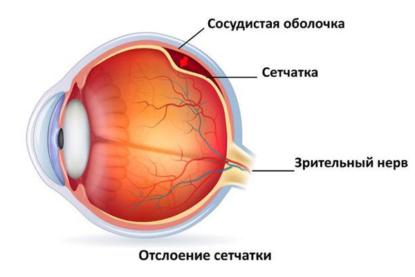 Ангиоматоз в строме что это. otsloenie setchatki s. Ангиоматоз в строме что это фото. Ангиоматоз в строме что это-otsloenie setchatki s. картинка Ангиоматоз в строме что это. картинка otsloenie setchatki s