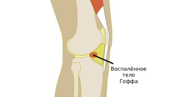 Болезнь Гоффа Болезнь Гоффа