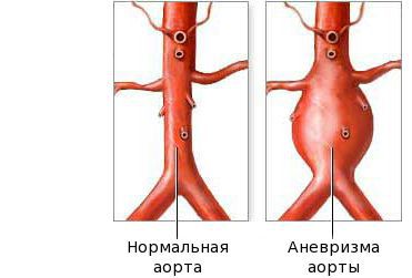 anevrizma aorty s