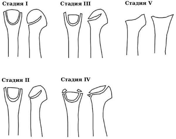 Изменения головки плюсневой кости при разных стадиях [4]