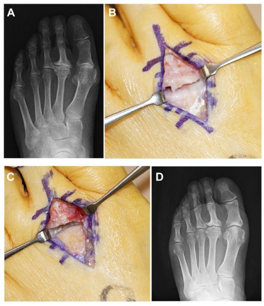 Открытый дебридмент. А и В — до операции (артроз 2-го плюснефалангового сустава, сужение суставной щели и остеофиты); С и D — после операции [4]