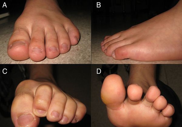 Отёк над тыльной поверхностью головки 2-й плюсневой кости (A и B). Ограничение подвижности 2-го плюснефалангового сустава (C и D) [6]